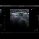 Tumorous infiltration of lymph nodes: US - Ultrasound